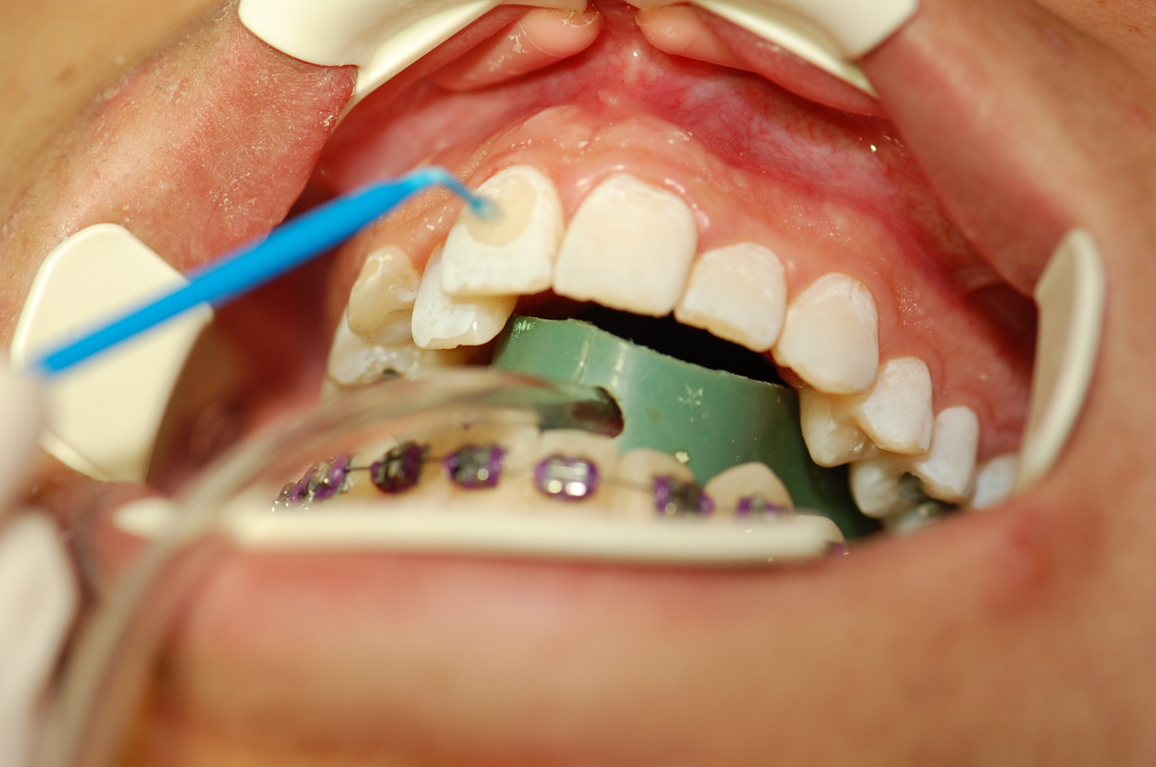 Redwood City Orthodontist Services