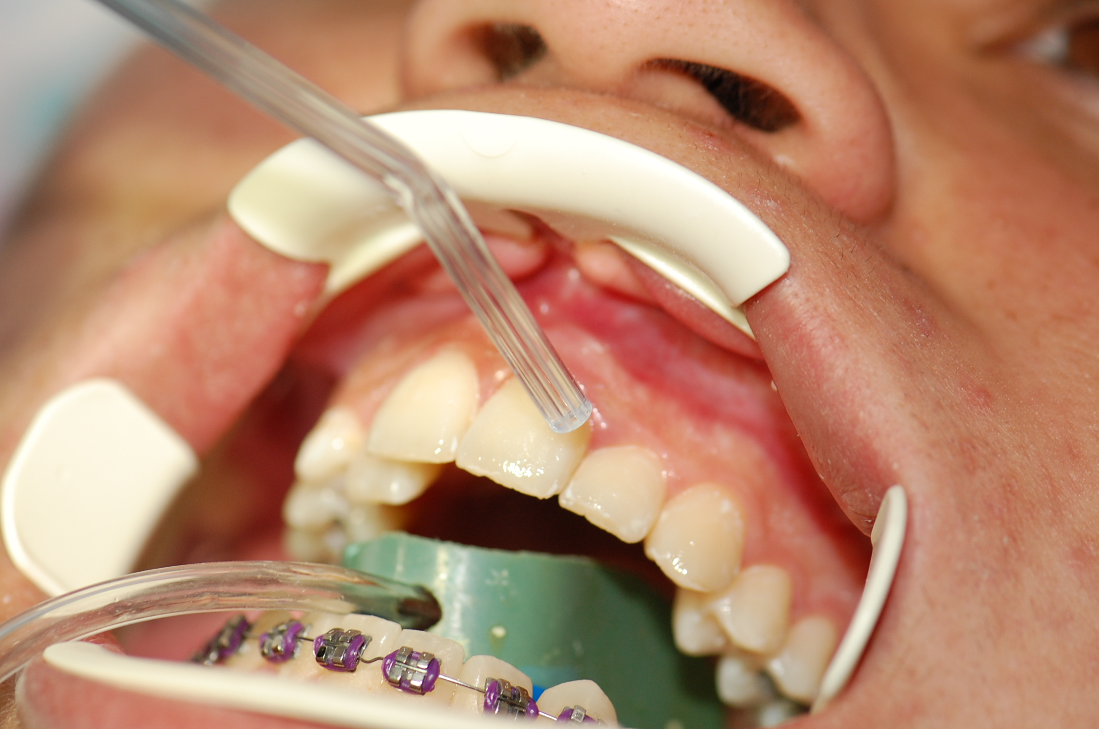 Redwood City Orthodontist Services