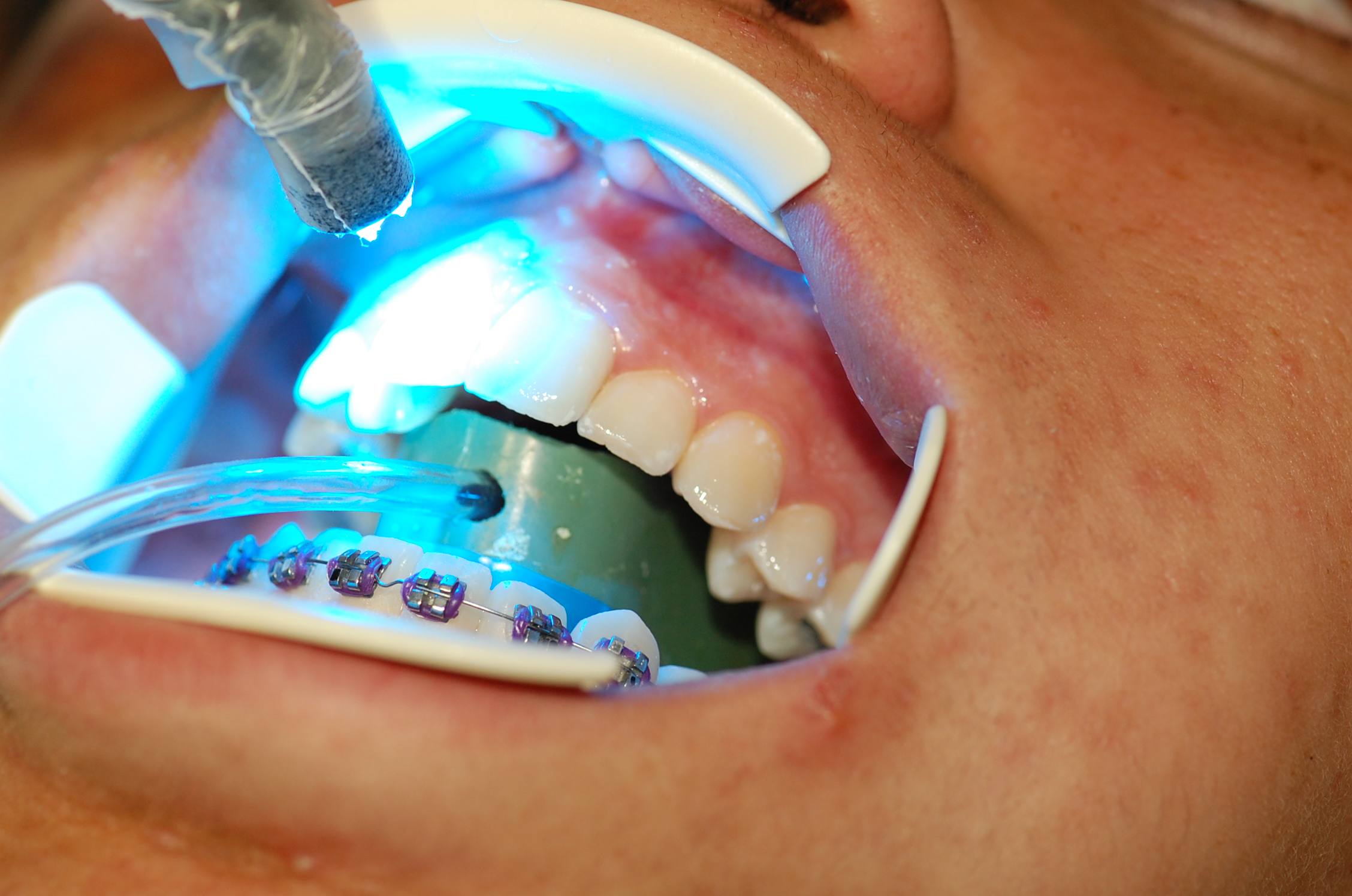 Redwood City Orthodontist Services