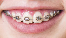 Types of Braces