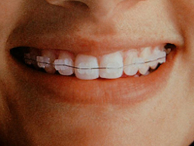 East Palo Alto Ceramic Braces