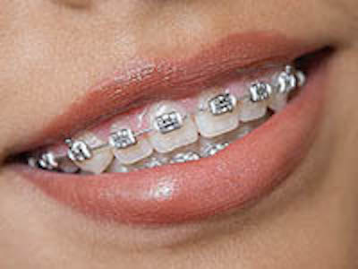 East Palo Alto Metal Braces