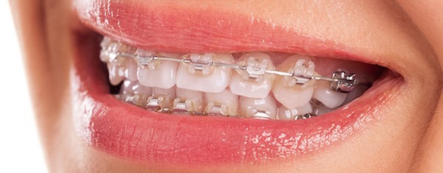 East Palo Alto Ceramic Braces