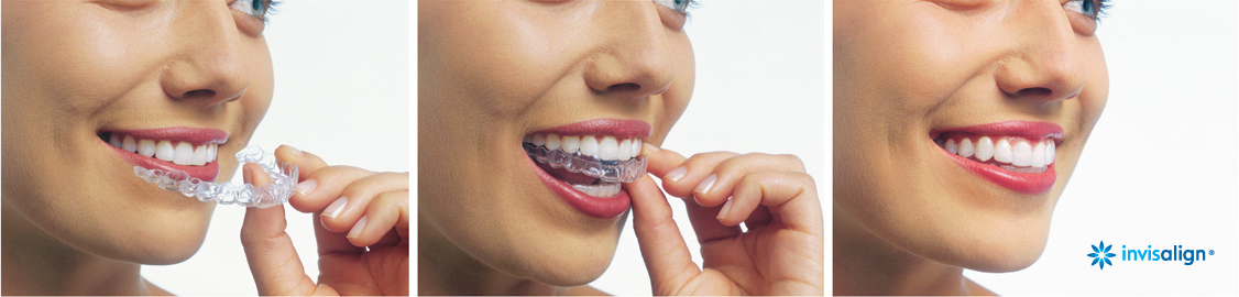 East Palo Alto Invisalign Services